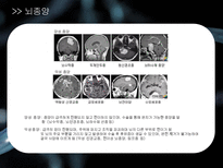 a++++ 칭찬받은 과제 신경계 뇌종양 뇌하수체 종양 수술간호 ppt 프레젠테이션 신경계란? / 뇌 / 뇌하수체 /뇌종양 /뇌하수체 종양 및 증상/경접형동 접근법 TSA/수술 과정/수술 전,후 간호/합병증 (해외논문)/합병증 예방 간호/퇴원 교육-8