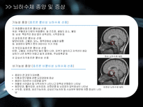 a++++ 칭찬받은 과제 신경계 뇌종양 뇌하수체 종양 수술간호 ppt 프레젠테이션 신경계란? / 뇌 / 뇌하수체 /뇌종양 /뇌하수체 종양 및 증상/경접형동 접근법 TSA/수술 과정/수술 전,후 간호/합병증 (해외논문)/합병증 예방 간호/퇴원 교육-11