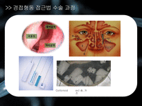 a++++ 칭찬받은 과제 신경계 뇌종양 뇌하수체 종양 수술간호 ppt 프레젠테이션 신경계란? / 뇌 / 뇌하수체 /뇌종양 /뇌하수체 종양 및 증상/경접형동 접근법 TSA/수술 과정/수술 전,후 간호/합병증 (해외논문)/합병증 예방 간호/퇴원 교육-13
