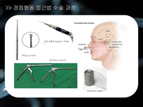 a++++ 칭찬받은 과제 신경계 뇌종양 뇌하수체 종양 수술간호 ppt 프레젠테이션 신경계란? / 뇌 / 뇌하수체 /뇌종양 /뇌하수체 종양 및 증상/경접형동 접근법 TSA/수술 과정/수술 전,후 간호/합병증 (해외논문)/합병증 예방 간호/퇴원 교육-14