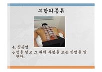 부항요법-18