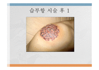 부항요법-19