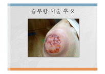 부항요법-20