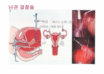 피임 레포트-6