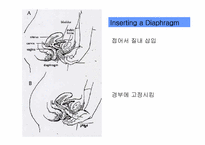 피임 레포트-13