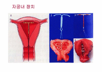 피임 레포트-14