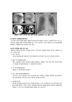 폐암 문헌고찰-6