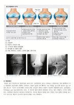 퇴행성 슬관절염인공관절치환술_간호과정사례적용보고서-8