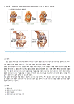 퇴행성 슬관절염인공관절치환술_간호과정사례적용보고서-11