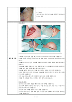 수술간호 사례보고서 유방암 유방 재건술 기동성장애 감염 위험성-5