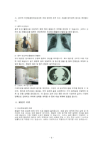 7 폐암 (Lung Cancer)-6
