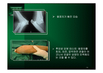 주관절 손상의 재활-14