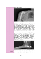 정형외과 골절(상완골, 중골) 케이스[Fracture of upper end of humerus Lt. Fracture Calcaneus closed Lt]-6