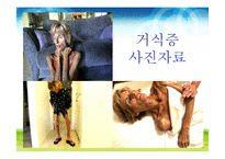 [영양학] 식사장애(식이장애)-5