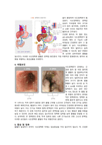 식도정맥류 케이스스터디-2