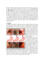식도정맥류 케이스스터디-3