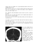 뇌동정맥기형 케이스스터디-2