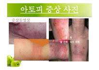 [화학] 아토피 피부염-11