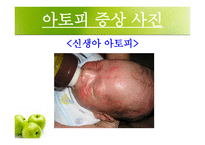 [화학] 아토피 피부염-12