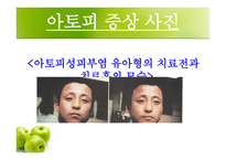 [화학] 아토피 피부염-13