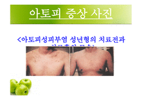 [화학] 아토피 피부염-14