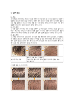 [의/약학] 탈모의 원인, 종류, 식이요법-3