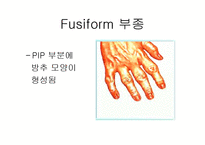 [의학, 작업치료학 ,간호학] 류마티스(RA) 골 관절염(OA) ppt-10