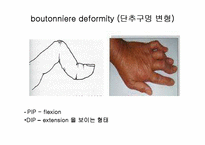 [의학, 작업치료학 ,간호학] 류마티스(RA) 골 관절염(OA) ppt-13