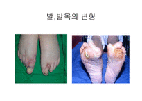 [의학, 작업치료학 ,간호학] 류마티스(RA) 골 관절염(OA) ppt-16