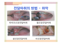 국소마취와 진정요법-17
