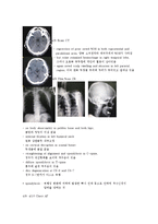 [간호학] 경막하 출혈 Subdural hemorrahage(SDH) 신체사정-7