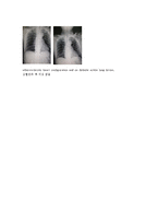 [간호학] 경막하 출혈 Subdural hemorrahage(SDH) 신체사정-8