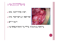 [간호학 레포트, 갑상선 질환] 갑상선 항진증-15