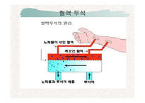 [혈액투석, 동정맥 문합술, 간호학, shunt op] 동정맥 문합술, shunt op-16