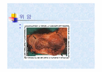[의학] 암에 대해서-10