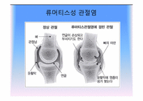 면역계의 장애 레포트-16