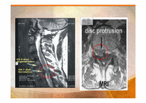 [물리치료학] 경추HNP(Herniated Nucleus Pulposus) 분석-8