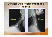 [물리치료학] 경추HNP(Herniated Nucleus Pulposus) 분석-9