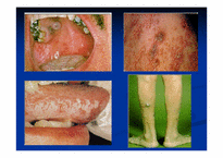 [간호학] 후천성 면역결핍증(Acquird immunodeficiency syndrome, AIDS)-6