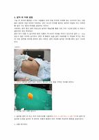 [간호학] 무통마취 -경막외 마취-3