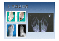 [보건교육] 하이힐이 발건강에 미치는 영향-7