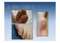 [보건교육] 하이힐이 발건강에 미치는 영향-12