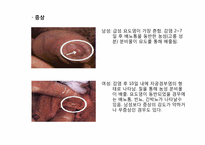 [성의생물학] Venereal Disease(성병)에 관한 분석-13
