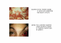 [성의생물학] Venereal Disease(성병)에 관한 분석-14