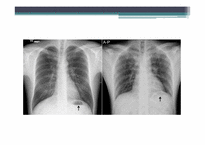 [PBL] Chest X-ray(흉부X-레이)-5