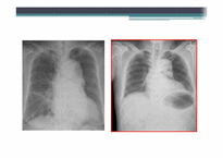 [PBL] Chest X-ray(흉부X-레이)-17