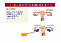 무월경(Amenorrhea)에 대하여-13