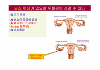무월경(Amenorrhea)에 대하여-14