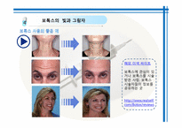[약과건강] 보톡스 사용에 대하여-15