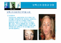 [약과건강] 보톡스 사용의 장단점-13